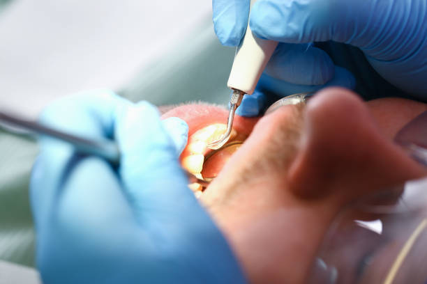 Best Emergency Treatment for Dental Infections or Abscesses in Brisbane, CA